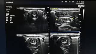 Intussusception Ultrasound [upl. by Luhem]