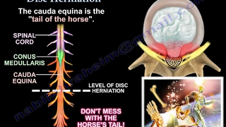 Disc Herniation  Everything You Need To Know  Dr Nabil Ebraheim [upl. by Port]