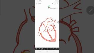 Constrictive Pericarditis  ventricular discordance expiratory hepatic vein flow reversal [upl. by Ahseikan]