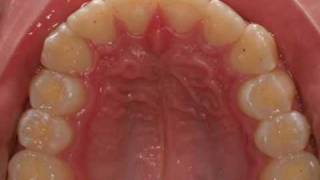 invisalign severe overjet [upl. by Camilo989]