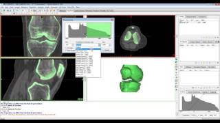 Tutorial Mimics Innovation Suite  Thresholding [upl. by Gagliano914]