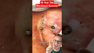 Crazy 10 Year Old BLACKHEADS REMOVAL shorts [upl. by Athalia]