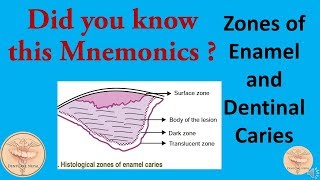 Mnemonics  Histological Zones of Enamel and Dentinal Caries [upl. by Myles]