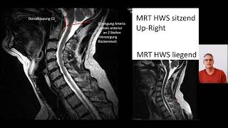 Up Right MRT der Kopfgelenke und der oberen HWS [upl. by Evelc]