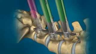 MIS Percutaneous Phoenix Screw Placement Bruce Frankel MD Charleston SC [upl. by Thetes]