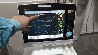 NIV Ventilator Settings  COVID19 Pneumonia ventilator settings in hindi [upl. by Merideth]