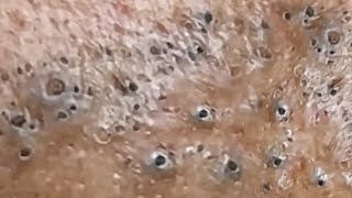 Blackheads amp Whiteheads Satisfying Removal 0048 [upl. by Hewe110]