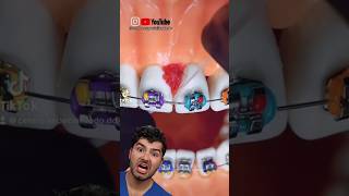 Braces Flossing Hack [upl. by Gaynor]