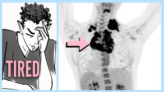 LYMPHOMA After Ignoring 6 WARNING Signs [upl. by Nyllij]