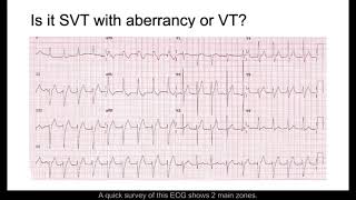 SVT with Aberrancy or VT [upl. by Nella]