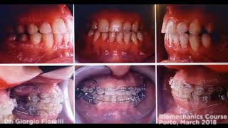 Iatrogenic Asymmetry Orthodontic case [upl. by Ximenez987]