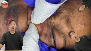 The MOST TERRIFYING Acne Squeezing Videos Youve Ever Seen 6 [upl. by Haraj802]