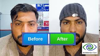 Successful Squint Correction Surgery and Patient Feeling  UrduHindi [upl. by Anaejer903]