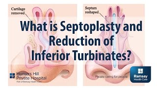 What is Septoplasty and reduction of Inferior Turbinates [upl. by Yenffit]