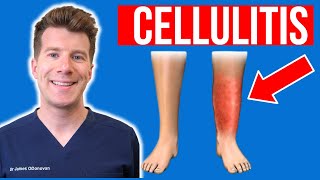 Doctor explains CELLULITIS skin infection  Causes symptoms treatment plus photos [upl. by Lette]