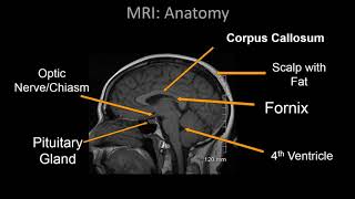 Normal Brain MRI Anatomy  Neuroradiology Made simple [upl. by Netsrek]