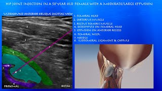 Ultrasound Guided Hip Joint Injection with in a 58 Year Old Female with a ModerateLarge Effusion [upl. by Toh]