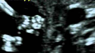 Fetal Medicine Foundation  Hand abnormality at 1113 weeks [upl. by Silvano]