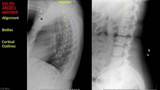 Introduction to Spine Radiographs [upl. by Eloc]