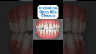 Can Invisalign fix open bite 2023 [upl. by Ludba]