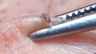 Very Black Blackheads removal with tweezers 3 [upl. by Yzeerb]