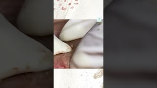 Big Cystic Acne Blackheads Extraction Blackheads amp Milia Whiteheads Removal Pimple Popping [upl. by Annaej]