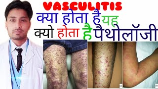 VASCULAITIS क्या है हिंदी what is vasculitis pathology [upl. by Aduhey]