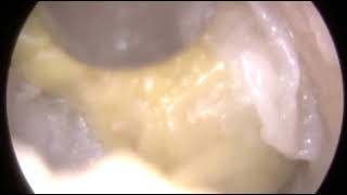 Otitis Externa and Discharge Removal  Ep 300 [upl. by Nomled]