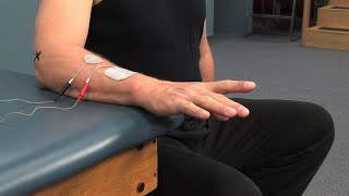 Electrode Placement for Finger Extension Muscle Stimulation [upl. by Sallad]