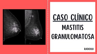 Caso Clínico 94 Mastitis granulomatosa [upl. by Decrem]