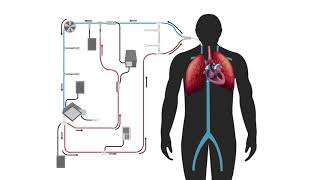 Modified Thermodilution in Extracorporeal Therapy [upl. by Airyt]