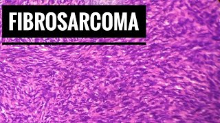 Fibrosarcoma Histopathology [upl. by Sillek]