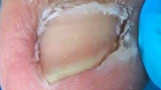 Thick dead skin stuck to toes gentle cleansing Pedicure [upl. by Ag]