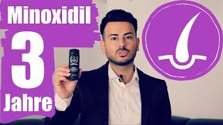 Meine Minoxidil 3 Jahre Erfahrung gegen Haarausfall und Geheimratsecken [upl. by Krute999]