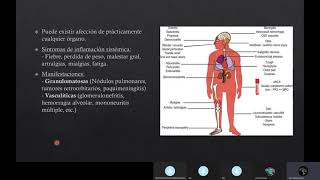 Granulomatosis con Poliangeitis [upl. by Anibur685]