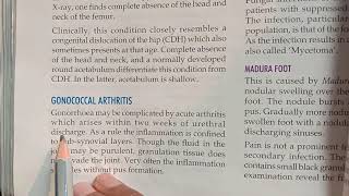 Gonococcal Arthritis [upl. by Breen]