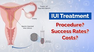 IUI Treatment Procedure Costs Success Rates [upl. by Card]