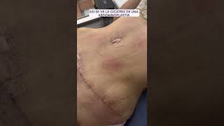 Cicatriz de una abdominoplastia  Dra lina Franco cirugiasplasticas [upl. by Valente]