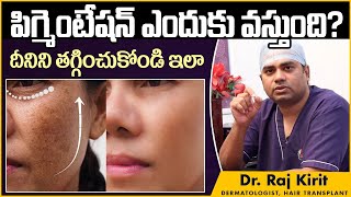 పిగ్మెంటేషన్ తగ్గాలంటే Causes Of Pigmentation Telugu  Dr Raj Kirit  Celestee Skin And Hair Clinic [upl. by Bruns851]