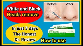 How to remove white and black heads  white or black heads khatm kry  betasalic ointment Dr review [upl. by Aiciram]