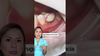 ¡Alerta Una verruga en la boca podría indicar una infección viral 👄❗ [upl. by Xonk67]