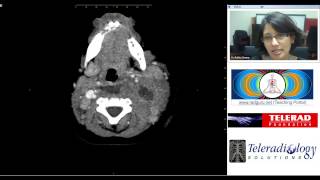 Retropharyngeal Abscess CT study by Dr Rekha Swamy [upl. by Helms]