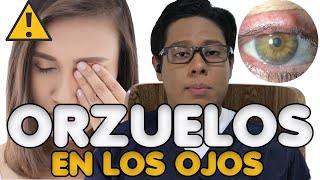 👀 Curar un Orzuelo 3 Tips Infalibles y Rápidos ¡Di Adiós a ese Orzuelo de Forma Efectiva 😲💥 [upl. by Shaylah]