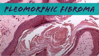 Pleomorphic fibroma looks like skin tag but relative of spindle cellpleomorphic lipoma pathology [upl. by Eibur771]