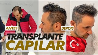 Transplante Capilar TURQUIA Antes e Depois  SUPER RESULTADO [upl. by Beattie]