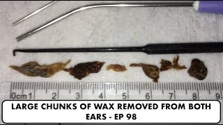 LARGE CHUNKS OF EAR WAX REMOVED FROM BOTH EARS  EP 98 [upl. by Vanden]