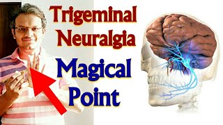 Acupressure Points For TRIGEMINAL NEURALGIA Acupressure For Trigeminal Neuralgia MADE EASY  HINDI [upl. by Disharoon]