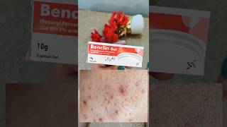 Benclin gel for acne pimples  comedones blackheads amp whiteheads shorts acne [upl. by Nnyllatsyrc]