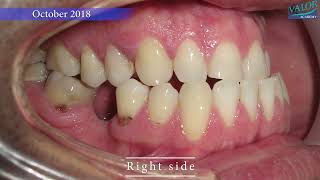 😲 JAW SURGERY and WISDOM teeth management 🦷💕 [upl. by Danais]