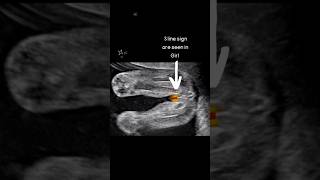 Ultrasound Scan Showing Baby Girl 👧 oldwivestales status pregnancy educational [upl. by Arda]